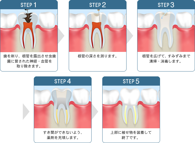 STEP1 歯を削り、根管を露出させ虫歯菌に冒された神経・血管を取り除きます。　STEP2 根管の深さを測ります。 STEP3 根管を広げて、すみずみまで清掃・消毒します。 STEP4 すき間ができないよう、薬剤を充填します。 STEP5 上部に被せ物を装着して終了です。